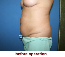 plastic-surgery-tummy-tuck